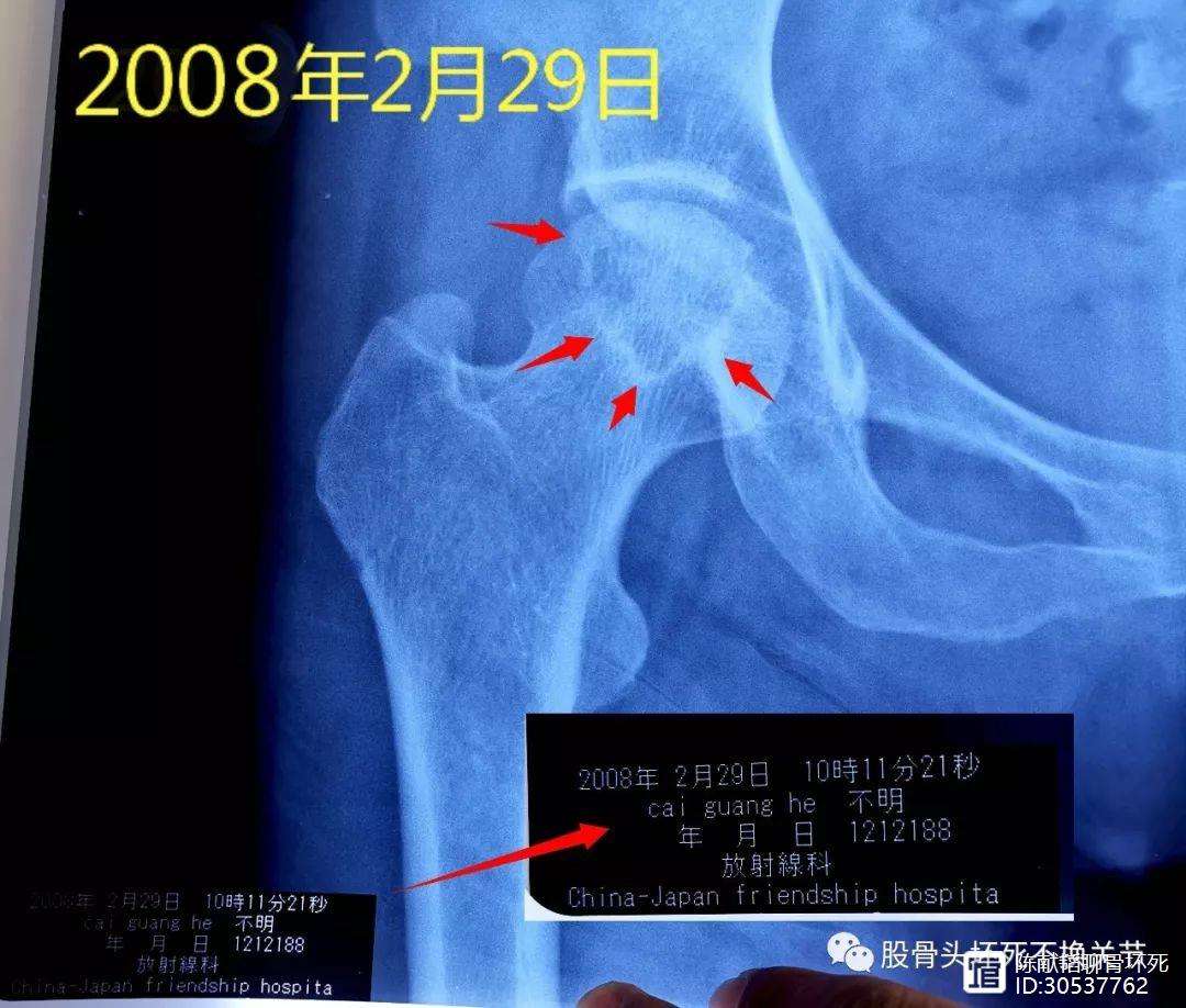 运城人工骨头医保报销多少(人工骨头医保报销多少比例)