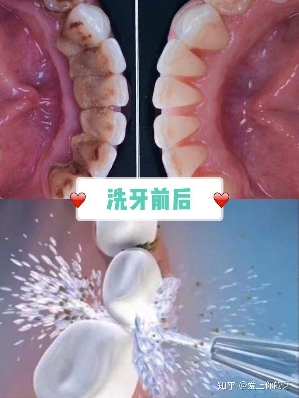 运城洗牙可以用医保吗(洗牙可以用医保吗,报销比例多少)